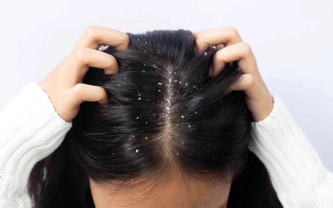 Nano-silver particles come to triumph in the battle against dandruff